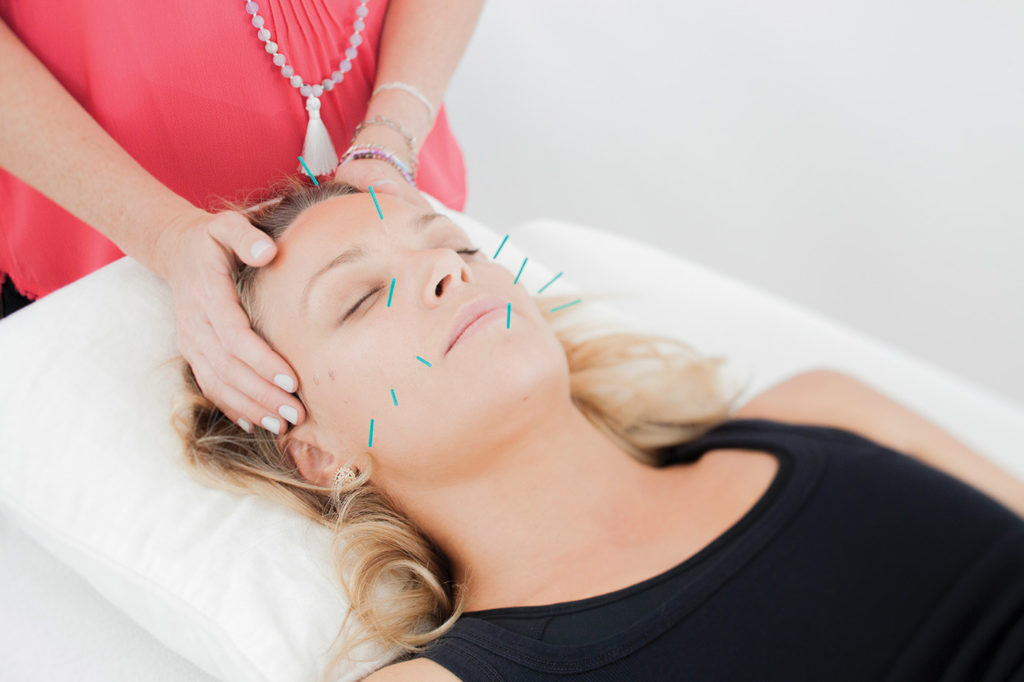 Facial Rejuvenation Acupuncture